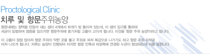 항문내에는 점액을 만들어 내는 샘이 4개에서 16개가 빙 둘러져 있는데, 이 샘의 입구를 통하여 세균이 침범하여 염증을 일으키면 항문주위에 종기처럼 고름이 고이게 됩니다. 이것을 '항문 주위 농양'이라고 합니다.

이 고름이 점점 많아져 항문 주위의 약한 곳을 뚫고 주위로 퍼져 복강으로 나가기도 하고 항문 주위 피부로 터져 나오게 됩니다. 치루는 농양이 진행되어 터지면 항문 안쪽과 바깥쪽에 연결된 누관이 형성되는데 이를 말합니다.   