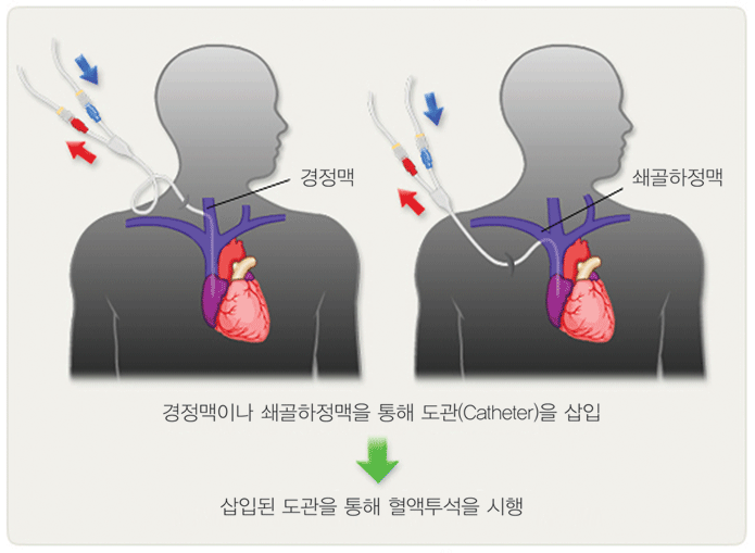 경정맥이나 쇄골하정맥을 통해 도관을 삽입 삽입된 도관을 통해 혈액투석을 시행
